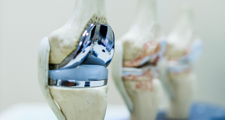 Types of Knee Replacement Surgery