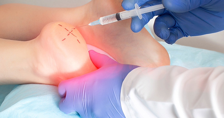 Plantar Fasciitis Surgery