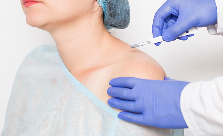 How is Shoulder Replacement Performed?