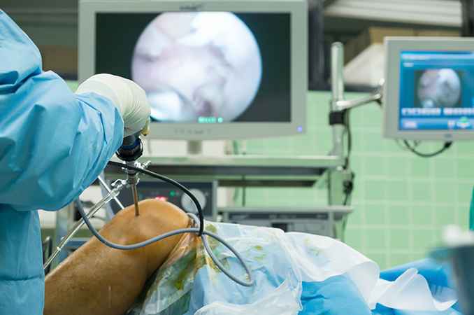 What Does ACL Reconstruction Treat?