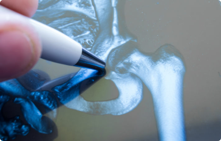 What are the Types of Hip Pain?