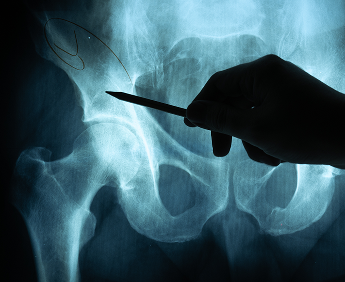 How to Prepare for Hip Replacement Surgery