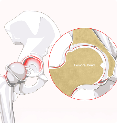 What Is a Hip Labral Tear?