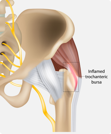 What is Hip Bursitis?