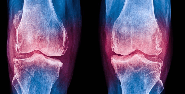 Understanding the Causes of Leg Fractures