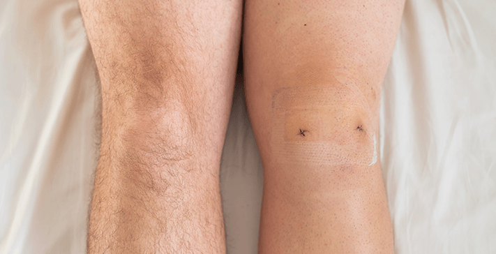 Risks of Keyhole (Laparoscopic) Meniscus Surgery