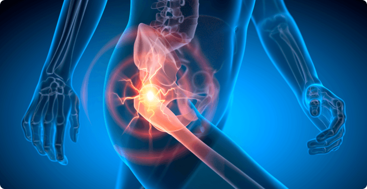 Types of Hip Arthritis
