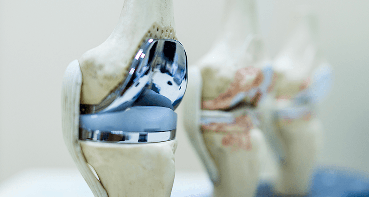 Types of Knee Replacement Surgery