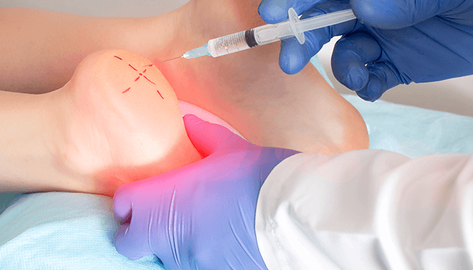 Plantar Fasciitis Surgery