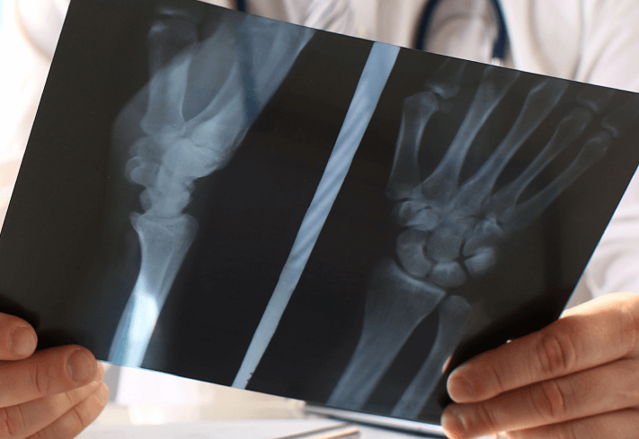 Types of Orthopaedic Trauma Injuries