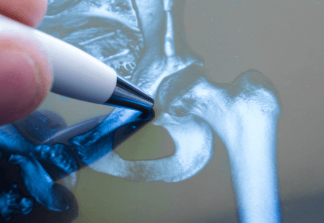  What are the Types of Hip Pain?