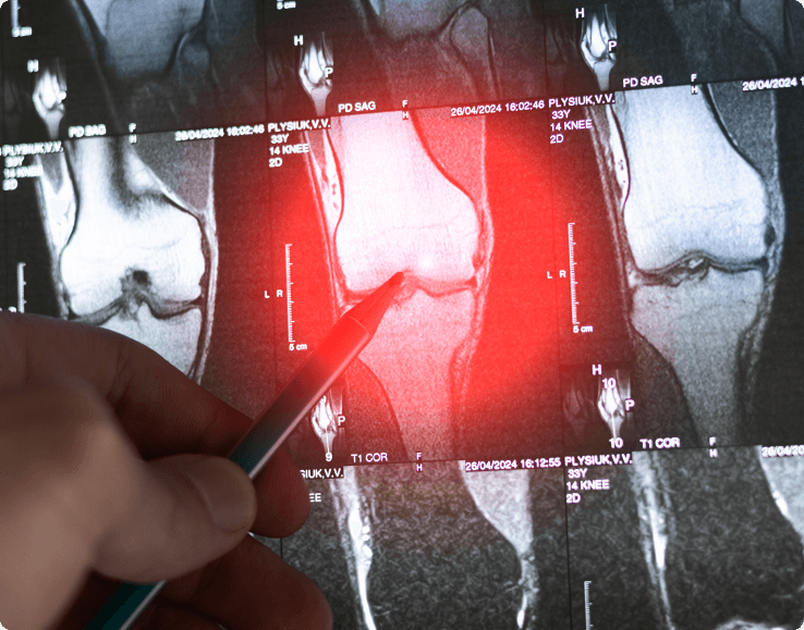 Types of Meniscus Tears