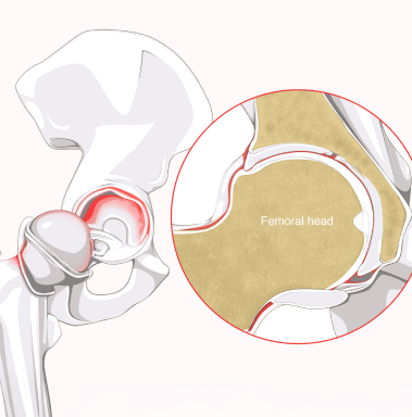 What Is a Hip Labral Tear?