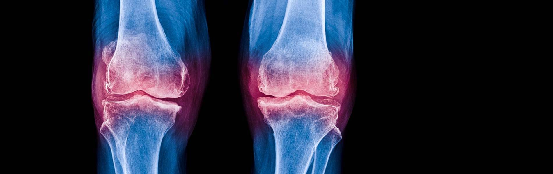Pengobatan Osteoporosis Singapura