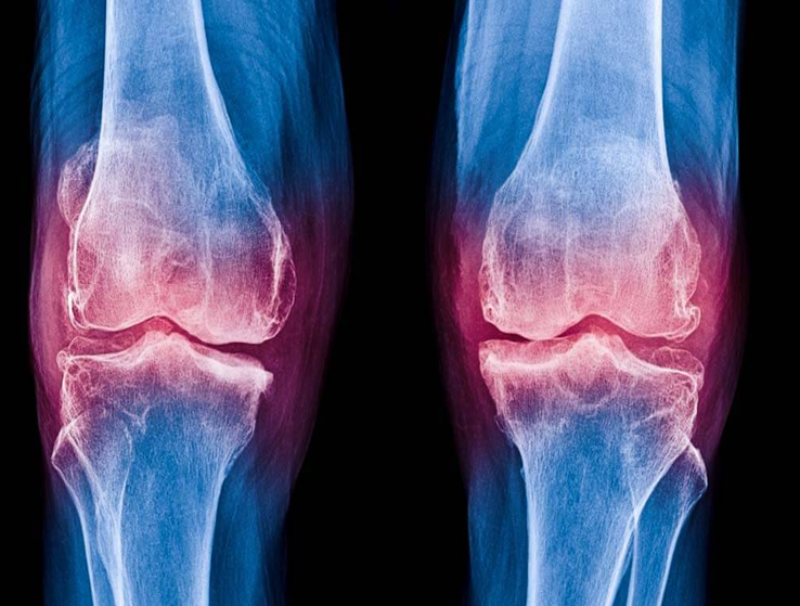 Understanding the Causes of Leg Fractures