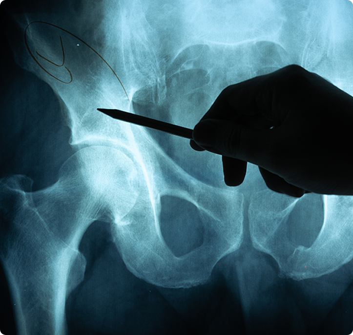 How Do I Prepare For Hip Replacement Surgery?