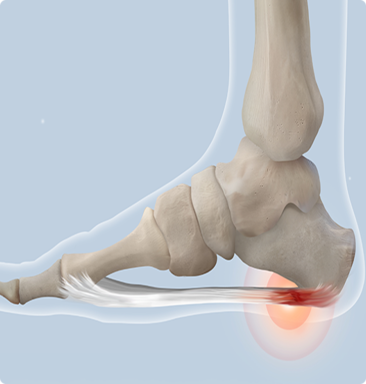 Plantar Fasciitis Faq