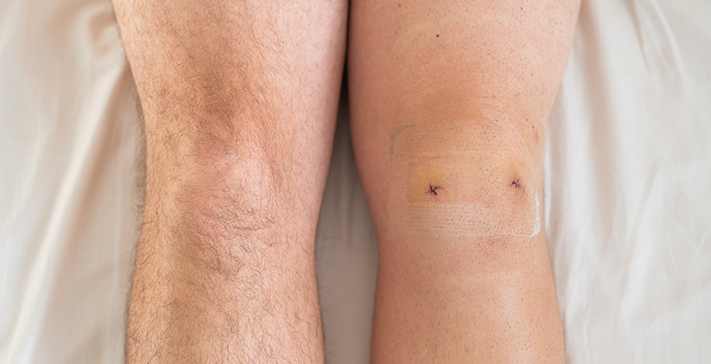 Risks of Keyhole (Laparoscopic) Meniscus Surgery