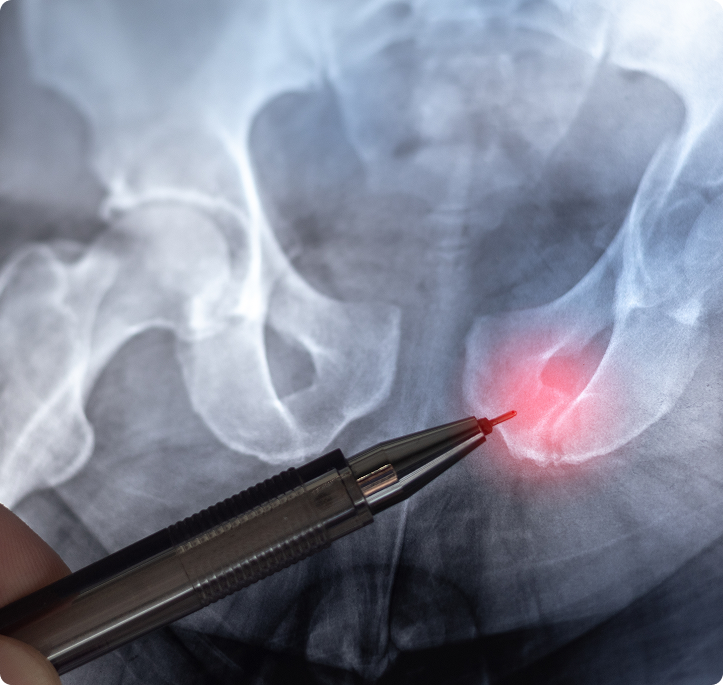 What Conditions Can Hip Replacement Address?