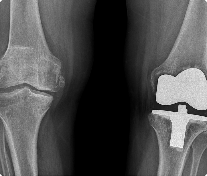 What Is The Difference Between Total (TKR) And Unicompartmental Knee Replacement (UKR)?